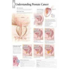  Understanding Prostate Cancer Laminated Poster – Scientific Publishing idegen nyelvű könyv