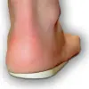  Valgus / pronációs korrekciós talpbetét 2231